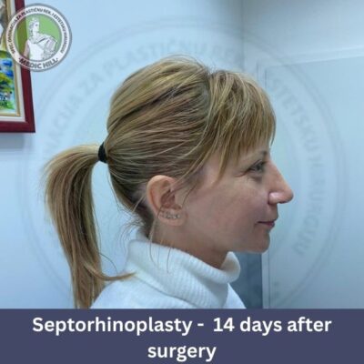 medic hill septorhinoplasty before - after pt 2 side view