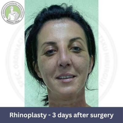 medic hill rhinoplasty before - after pt 3 front view