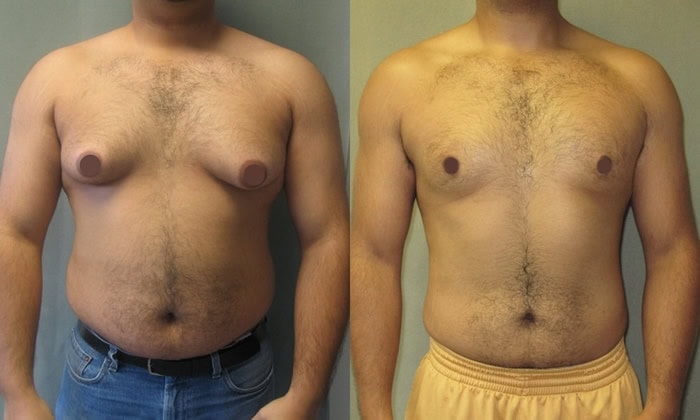 before and after gynecomastia Serbia