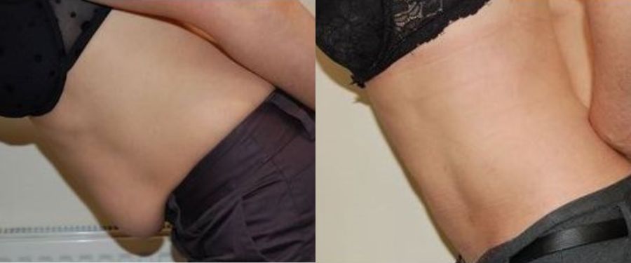 Liposuction Serbia before and after high-def results