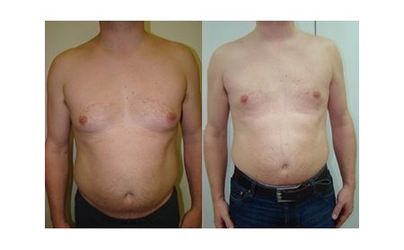 male breast reduction belgrade before and after