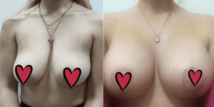 Mastopexy Serbia before-and-after results high-def