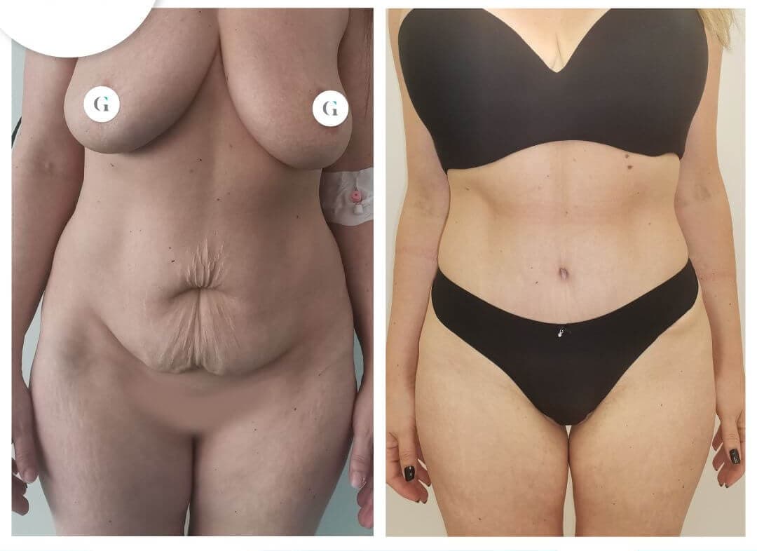 before and after tummy tuck belgrade