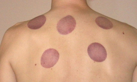 Is Michael Phelps Cupping His Way To Victory?