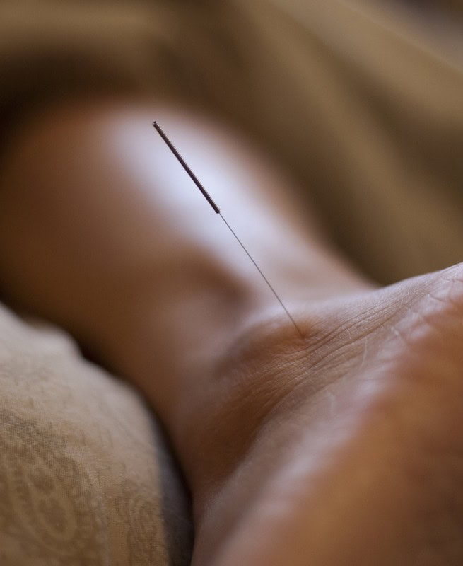Can Acupuncture Help Runners with Recovery?