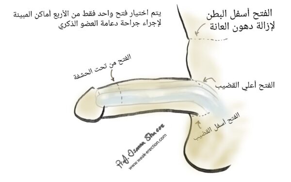الفتح الجراحي لدعامة العضو الذكري