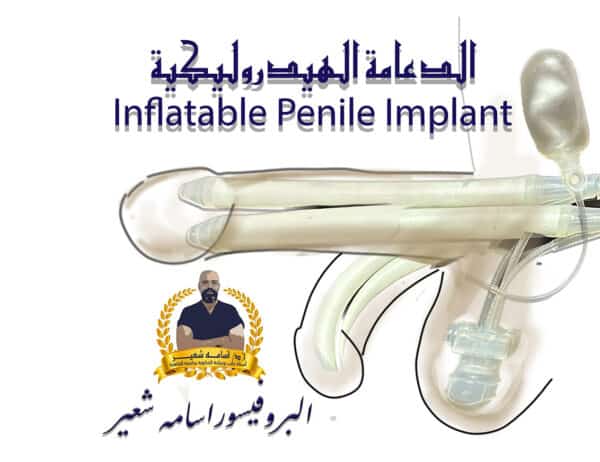 ‏الدعامة الهيدروليكية لعلاج ضعف الانتصاب Inflatable penile Implant for Erectile Dysfunction - ED