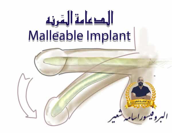 ‏الدعامة المَرِنه Malleable Implant