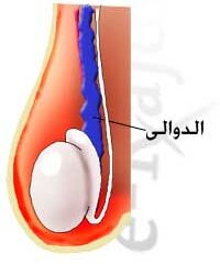 varicocelectomy ، microsurgical varicocelectomy ، varicocele ، varicocele embolization ، دوالي الخصية ، جراحة دوالي الخصية ، دوالي الخصية الميكروسكوبيه