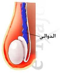 varicocelectomy ، microsurgical varicocelectomy ، varicocele ، varicocele embolization ، دوالي الخصية ، جراحة دوالي الخصية ، دوالي الخصية الميكروسكوبيه