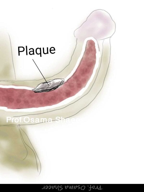 Peyronie's plaque surgery جراحة بيروني