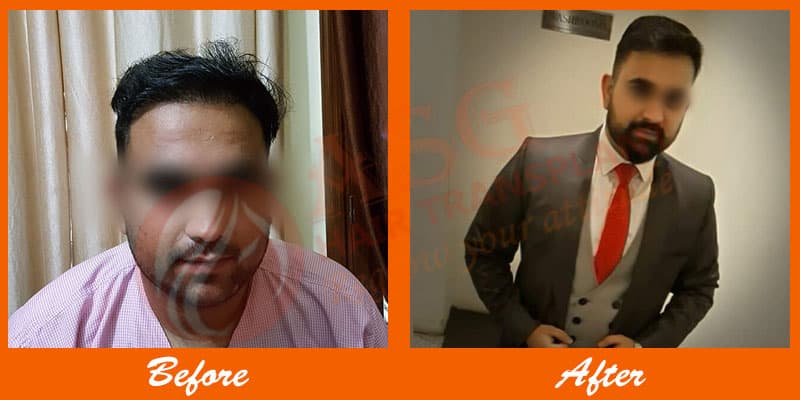 Limited hair loss facial hair restoration patient transformation after hair transplant surgery.