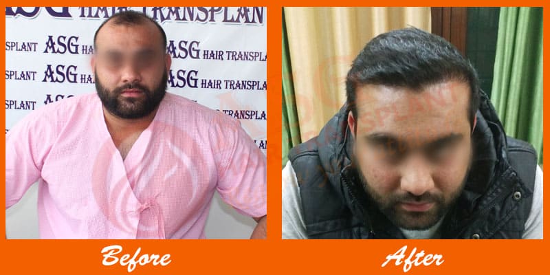 body hair transplant results