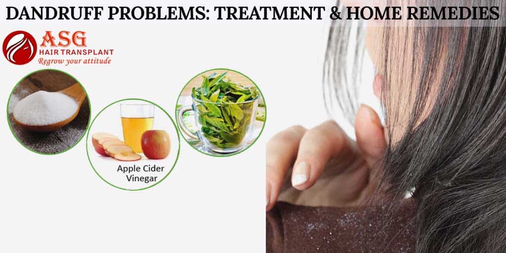 Dandruff Problems: Treatment & Home Remedies