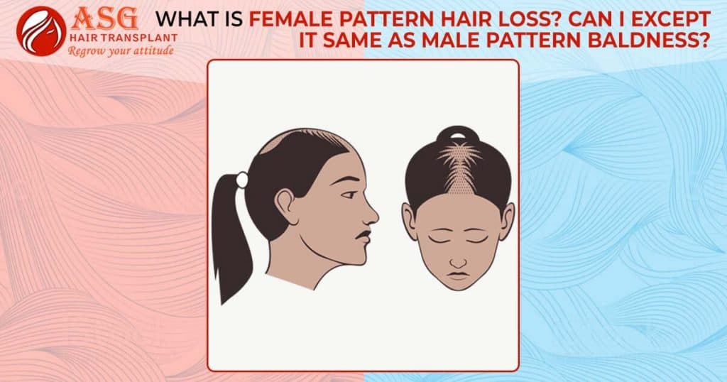 What is female pattern hair loss?