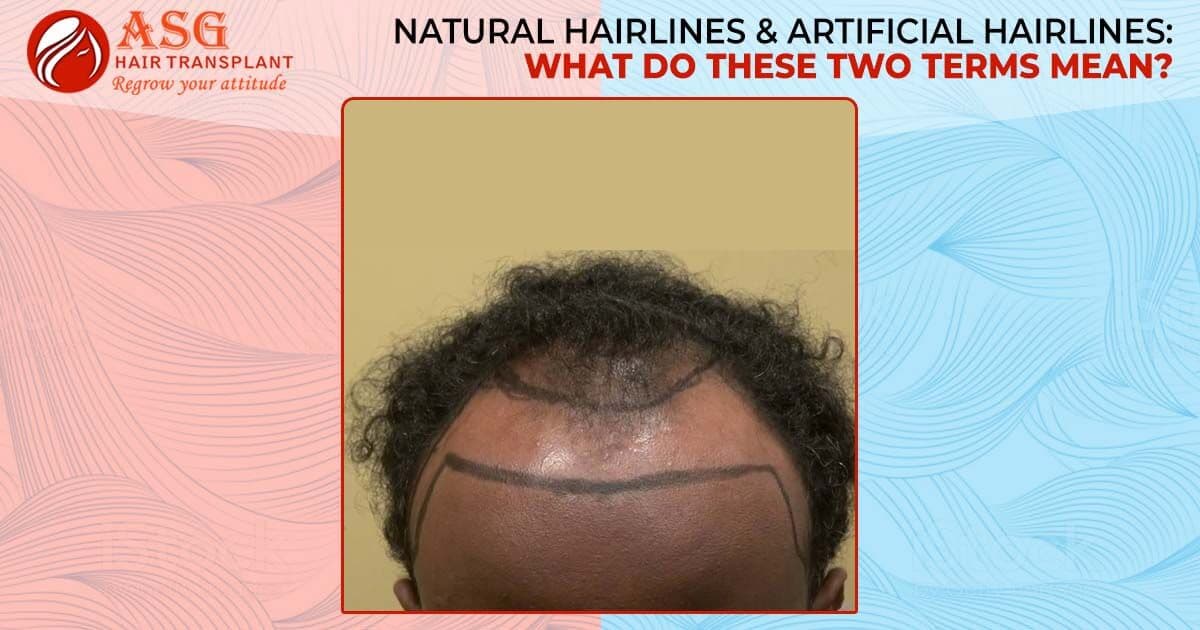 Natural Hairlines & Artificial Hairlines: What Do These Two Terms Mean?