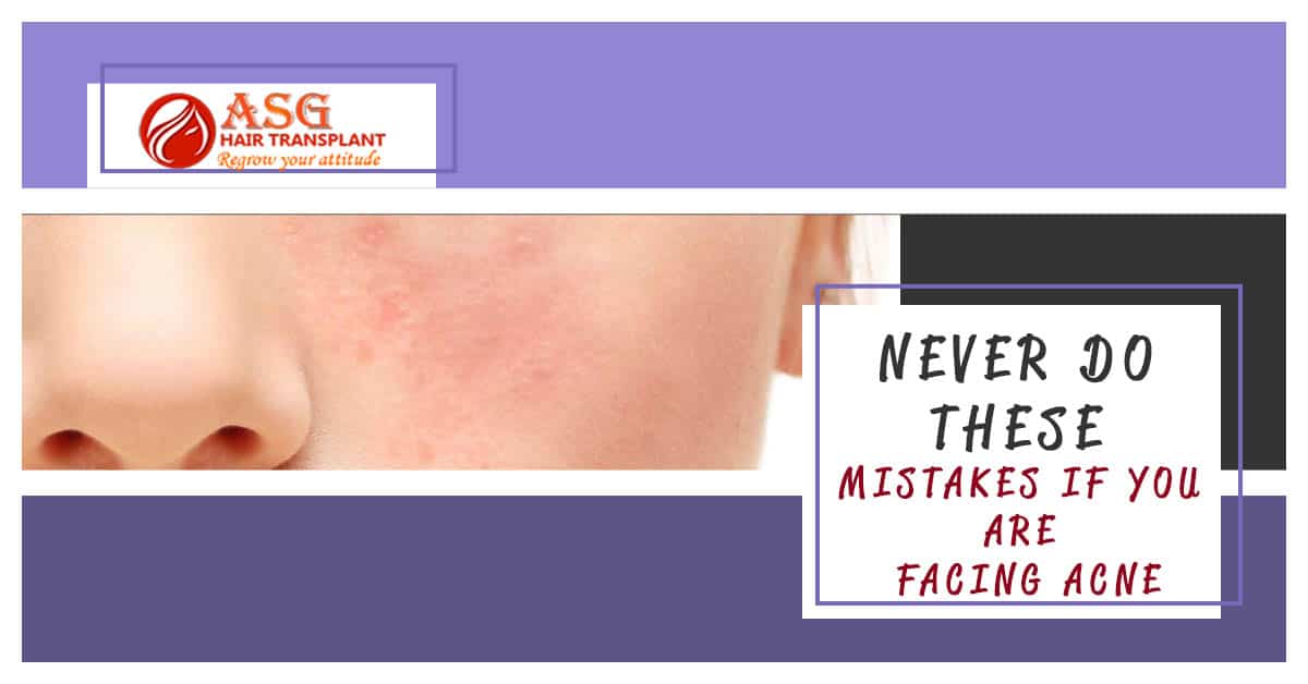 Never Do These mistakes if you are facing acne