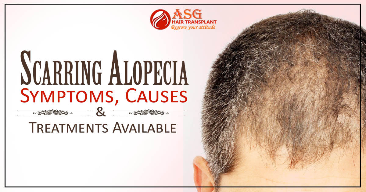 Scarring Alopecia - Symptoms, Causes And Treatments Available