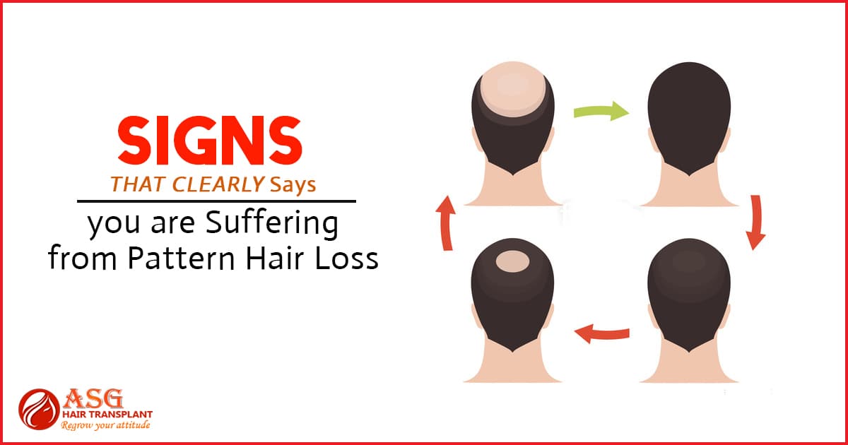 Signs That Clearly Says you are suffering from pattern hair loss