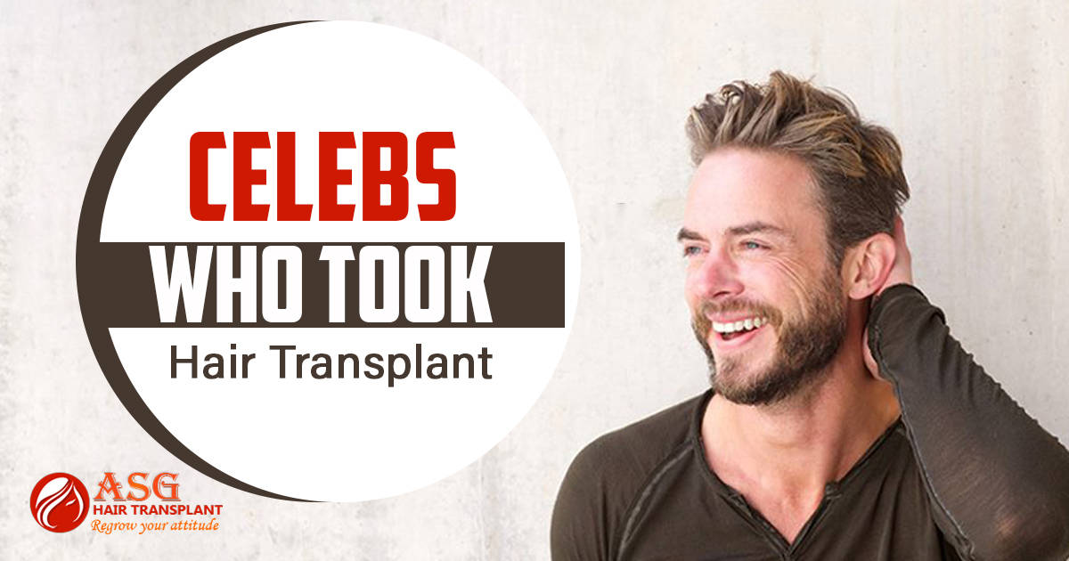 Celebs who took hair transplant Punjab
