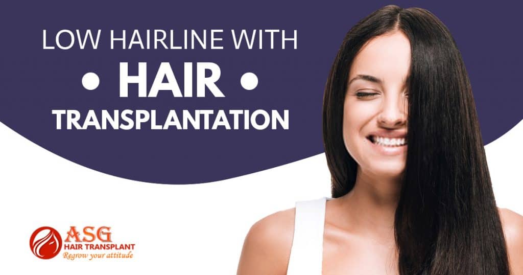 Low hairline with hair transplantation Punjab