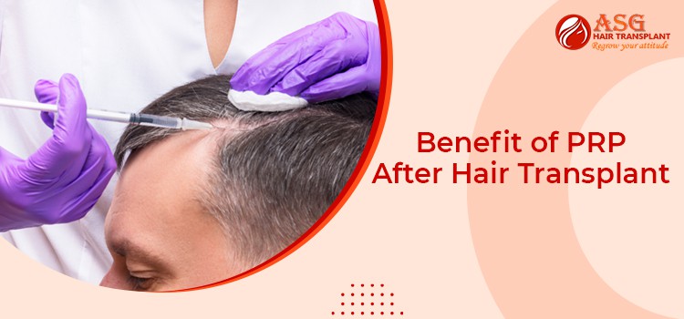 Benefit of PRP After Hair Transplant