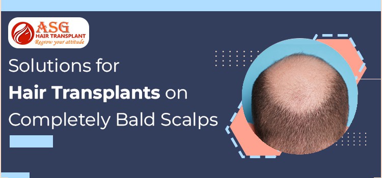 Solutions-for-Hair-Transplants-on-Completely-Bald-Scalps