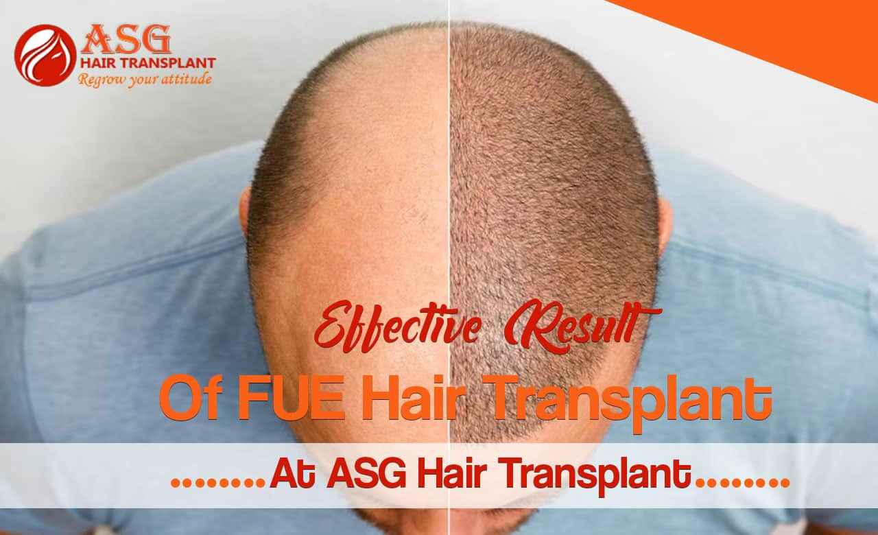 Effective Result Of FUE Hair Transplant At ASG Hair Transplant