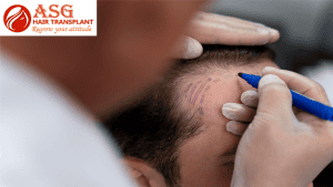 Thorough hair transplant consultation for optimal hair restoration results.
