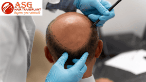 Expert Guidance to Prepare for Hair Transplant Surgery