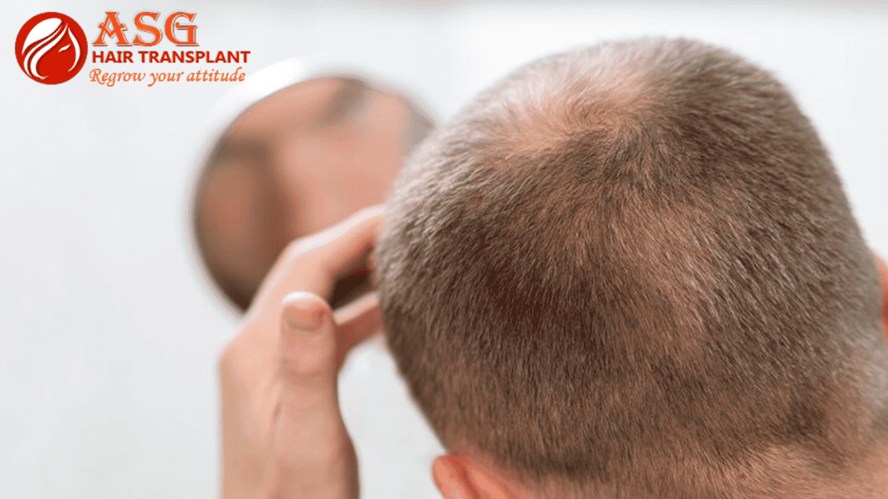Thinning hair scalp consultation for hair transplant, close-up of a man inspecting hair density in front of a mirror.