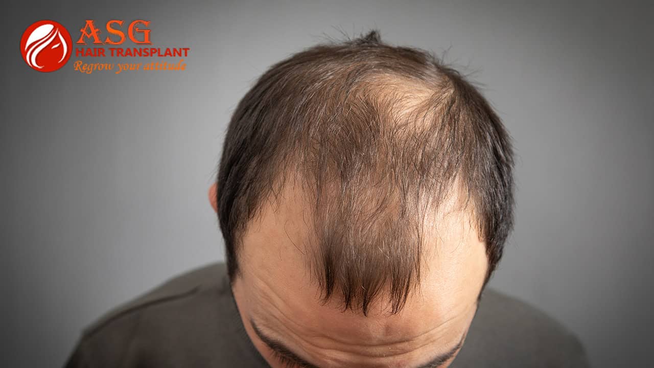 Alopecia and Its Types | Causes, Symptoms & Understanding Hair Loss