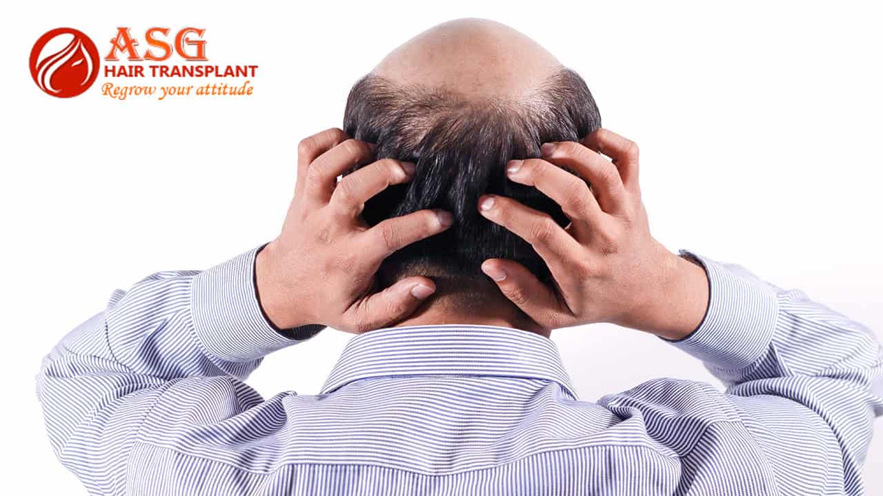 Best Age for Hair Transplant | Ideal Timing for Lasting Results