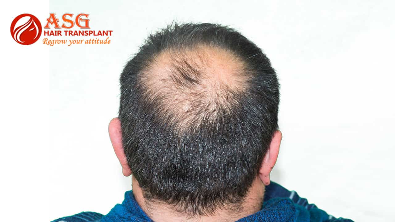 Hair Transplant for Alopecia | Effective Treatment for Androgenetic Alopecia