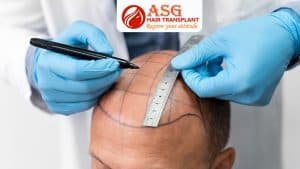Highly detailed image of a hair transplant consultation with precise scalp measurement and markings for hair restoration.