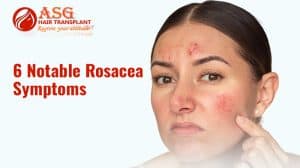Red, inflamed face with acne and rosacea symptoms, close-up portrait of a woman with skin irritation.