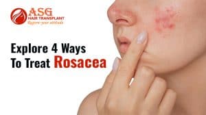 Explore-4-ways-to-treat-rosacea-advanced-skin-care-solutions.jpg.