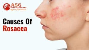 Red rash on woman's cheek caused by rosacea, a common skin condition treatable with hair transplant clinic solutions.