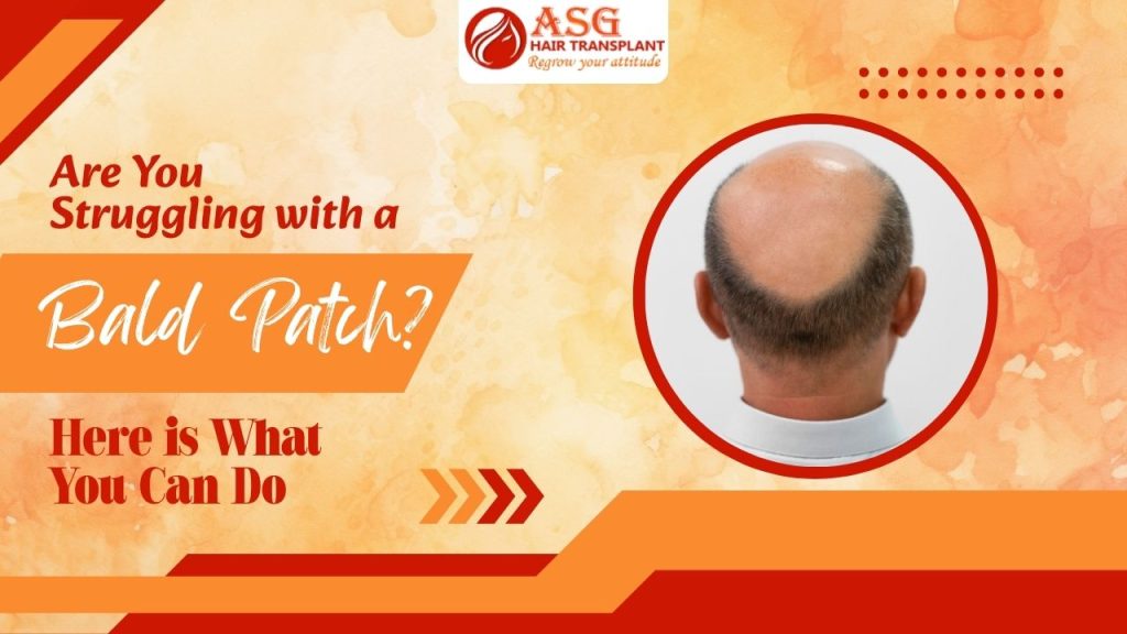 Close-up of a bald patch on a person's scalp, with suggestions on how to treat hair loss.