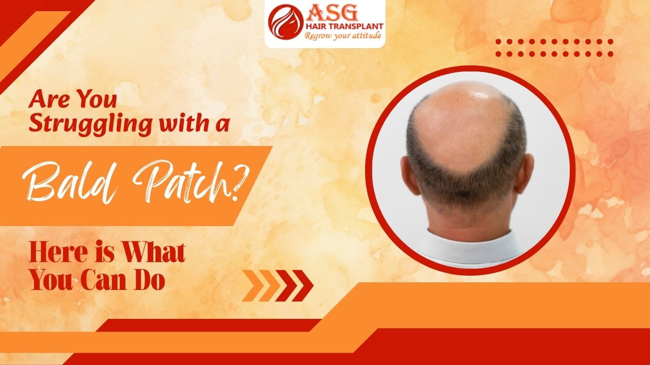 Close-up of a bald patch on a person's scalp, with suggestions on how to treat hair loss.