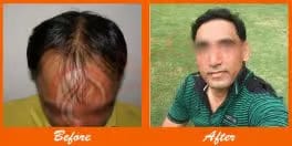 Hair transplant results before and after at ASG Hair Transplant Centre.
