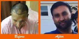 Healthy scalp during hair transplant procedure.