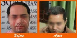 Thickened hairline after ASG Hair Transplant procedure.