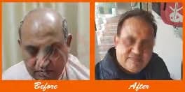 Fine hair transplant procedure showing before and after results at ASG Hair Transplant Centre.