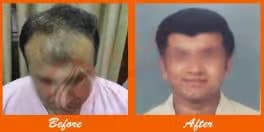Thinning hair before and full hair after transplant at ASG Hair Transplant Centre.