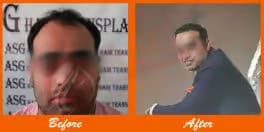 Fine hair transplant surgery before and after results at ASG Hair Transplant Centre.