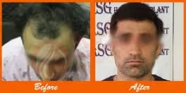 Natural-looking hair restoration results at ASG Hair Transplant Centre.