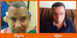 Thinning hair before and after hair transplant at ASG Hair Transplant Centre.