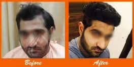 Healthy male patient before and after hair transplant results at ASG Hair Transplant Centre.