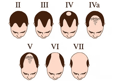 Baldness pattern diagram showing different stages of hair loss in men.